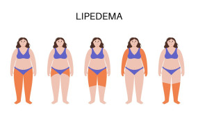 lipedema stock lipedema stock