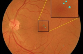 ep imagenfondoojolasistemadetectado lesiones rojas precursorasretinopatia diabetica