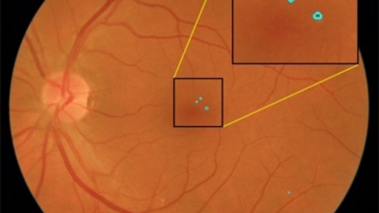 Imagen de fondo de ojo en la que el sistema ha detectado lesiones rojas, precursoras de retinopatía diabética. | R. ROMERO/SINC ep imagenfondoojolasistemadetectado lesiones rojas precursorasretinopatia diabetica