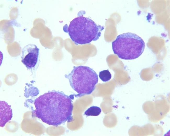 Leucemia megacarioblástica aguda | ST. JUDE CHILDREN'S RESEARCH HOSPITAL / TINA MOTRO ep leucemia megacarioblastica aguda
