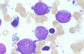 ep leucemia megacarioblastica aguda
