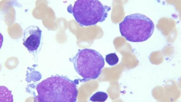 ep leucemia megacarioblastica aguda