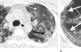 ep tc de torax de un hombre de 29 anos de edad afectado con coronavirus con historial de exposicion ep tc de torax de un hombre de 29 anos de edad afectado con coronavirus con historial de exposicion