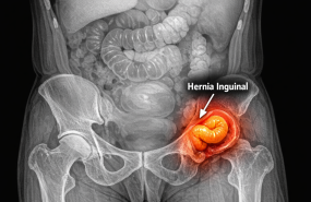 hernia inguinal hernia inguinal