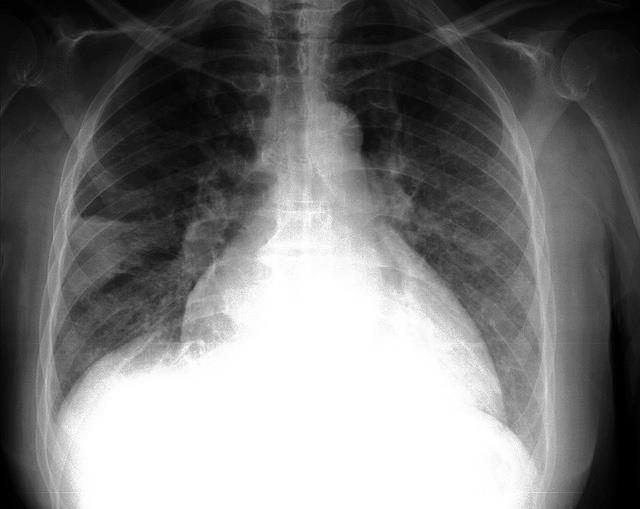 Patología pulmonar | FLICKR/PULMONARY PATHOLOGY/CC BY-SA 2.0 - Archivo ep patologia pulmonar
