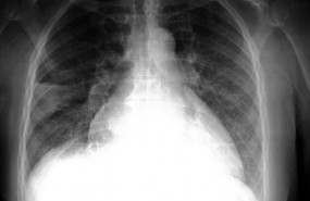 ep patologia pulmonar