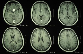 ep meningioma tumor cerebro