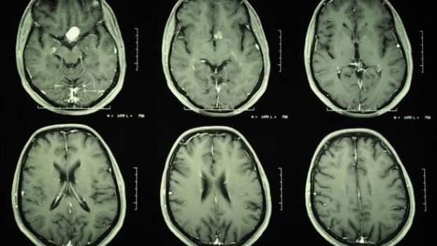 ep meningioma tumor cerebro