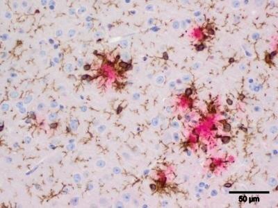ep placa beta amiloidealzheimer