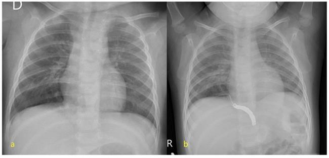 ep tratansecuestro pulmonarembolizacionvezconcirugia clasica