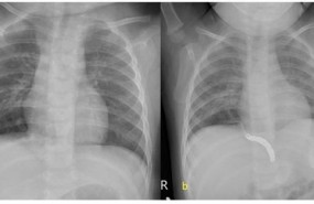 ep tratansecuestro pulmonarembolizacionvezconcirugia clasica