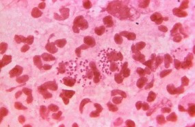 ep neisseria gonorrhoeae gonorrea
