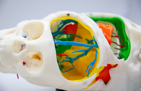 modelo 3d ciruga crneo siamesas modelo 3d ciruga crneo siamesas