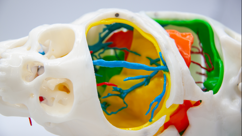 modelo 3d ciruga crneo siamesas