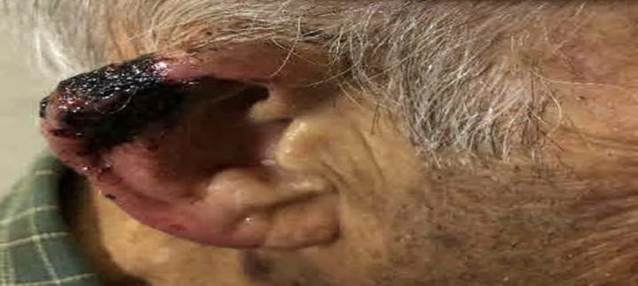 Pretratamiento del oído del paciente: un paciente anciano en terapia anticoagulante con cáncer de células escamosas del oído. | STUDY AUTHOR AND RSNA ep pretratamiento del oido del paciente un paciente anciano en terapia anticoagulante con cancer de