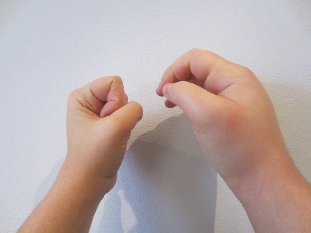 Hinchazón en una mano causada por angioedema hereditario | EMEL AYGÖREN-PÜRSÜN ep hinchazonuna mano causadaangioedema hereditario