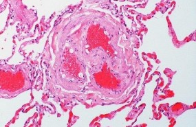 ep trombosis