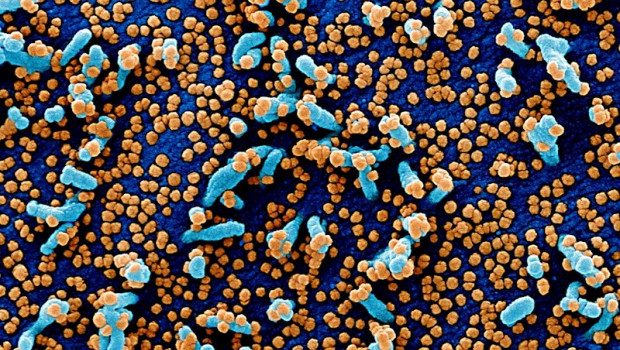 ep micrografia electronica de barrido coloreada de una celula vero e6 en azul infectada con