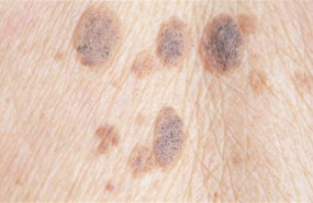 ep melanoma 20190724175016