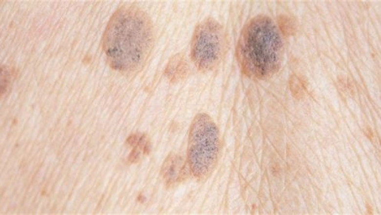 MELANOMA | TWITTER - Archivo ep melanoma 20190724175016