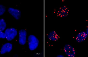 ep celulas de un neuroblastoma los puntos rojos marcan los sitios donde la proteina brca1 ocurre en