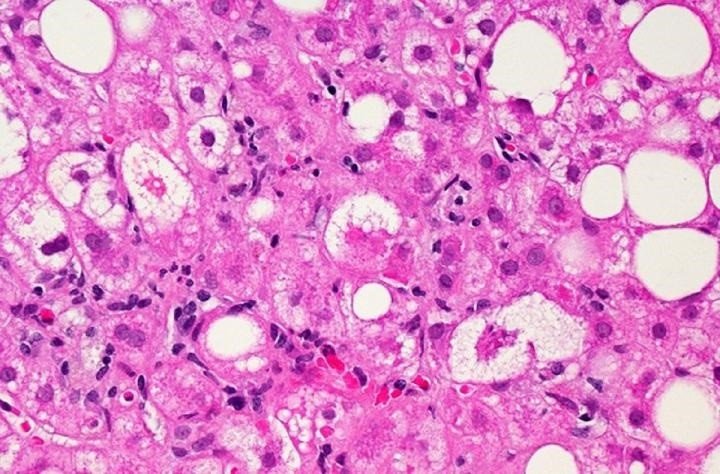 ep tejido hepatico afectado por la enfermedad del higado graso no alcoholico ep tejido hepatico afectado por la enfermedad del higado graso no alcoholico