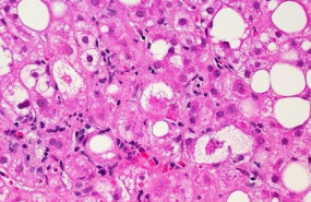 ep tejido hepatico afectado por la enfermedad del higado graso no alcoholico