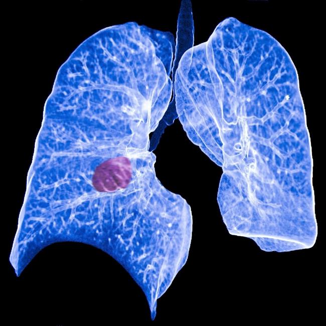 ep cancerpulmon 20170530143102