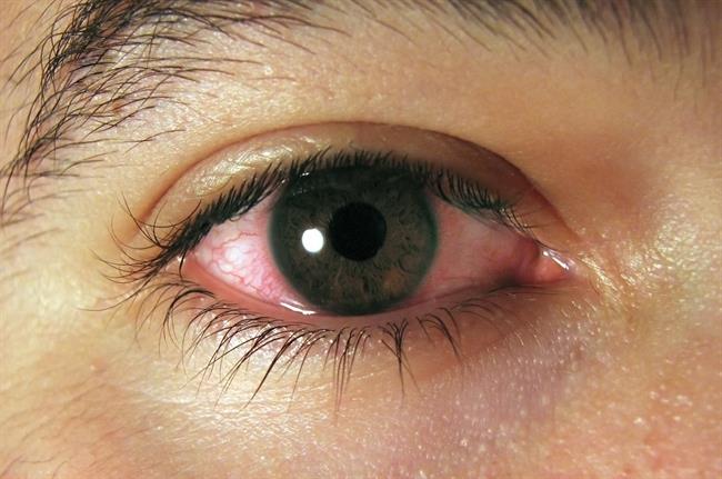 ep conjuntivitis ojos rojos