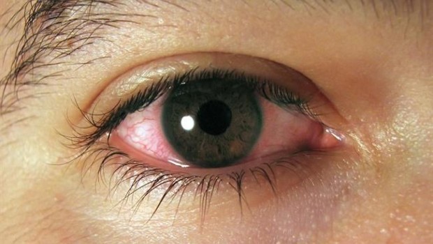 ep conjuntivitis ojos rojos