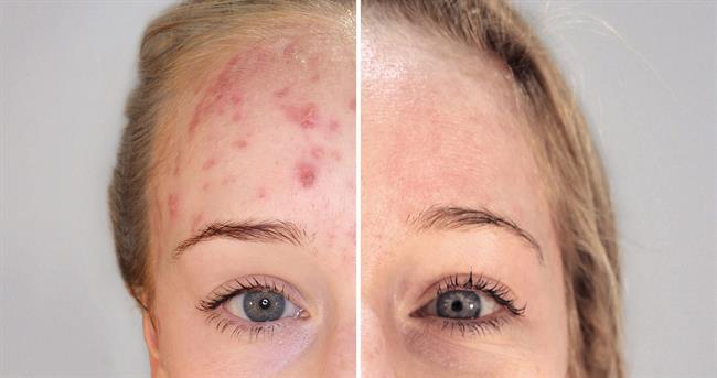 Terapia biofotónica para el tratamiento del acné en la mujer madura | INSTITUTO DE DERMATOLOGÍA INTEGRAL ep terapia biofotonicatratamientoacne enmujer madura