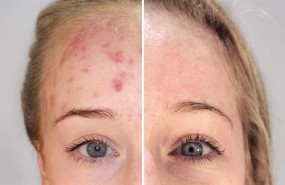 ep terapia biofotonicatratamientoacne enmujer madura
