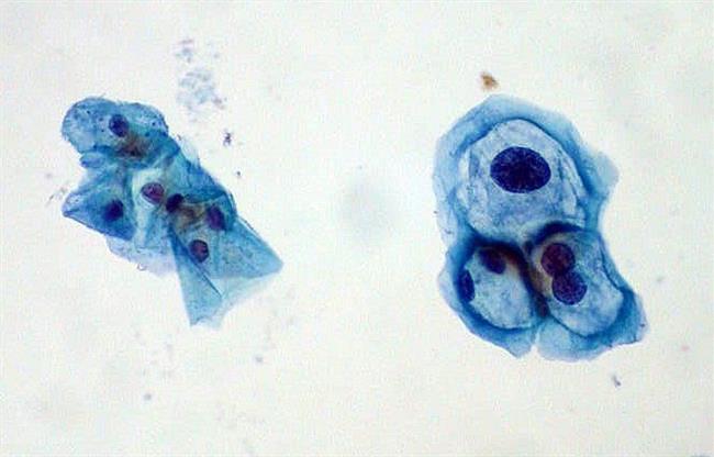 ep viruspapiloma humano vph