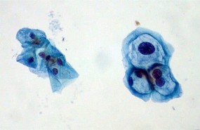 ep viruspapiloma humano vph