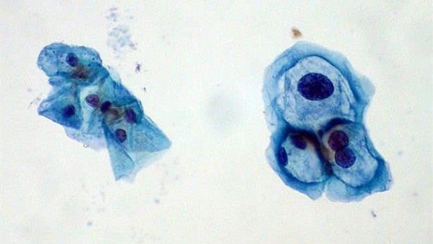ep viruspapiloma humano vph