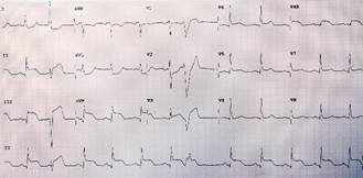 ep infarto de miocardio con elevacion del segmento st