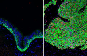 ep tejido normal de las vias respiratorias izquierda y tejido canceroso del pulmon derecha con una