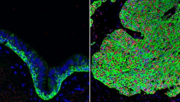 ep tejido normal de las vias respiratorias izquierda y tejido canceroso del pulmon derecha con una