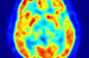 ep cerebro recurso neuronas