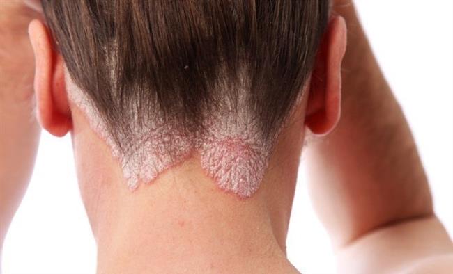 Psoriasis | TWITTER ep psoriasis 20180221110202