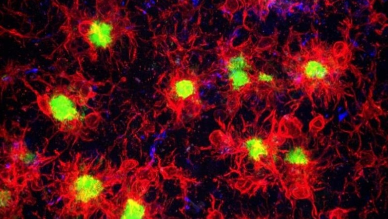 La microglia, que se muestra en rojo, rodea y reacciona a las placas beta amiloides, que se muestran en verde, en el cerebro con enfermedad de Alzheimer. | KIM GREEN LAB / UCI ep la microglia quemuestrarojo rodeareaccionalas placas beta amiloides quemuestranverde encerebroenfermedadalzheimer