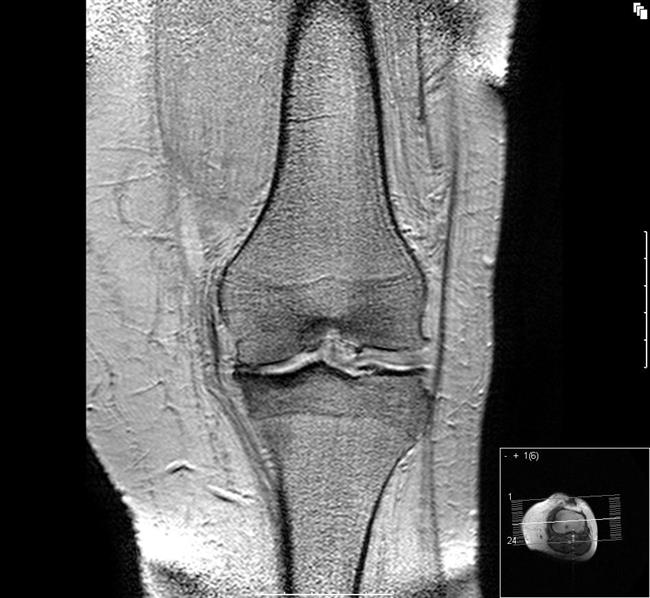 Artrosis de rodilla | UAM ep artrosisrodilla