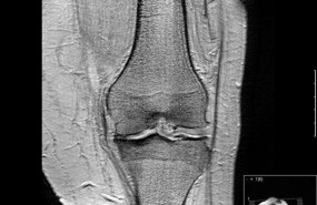 ep artrosisrodilla