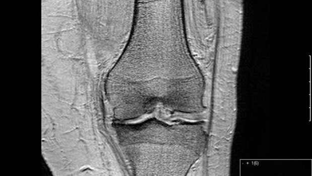 ep artrosisrodilla