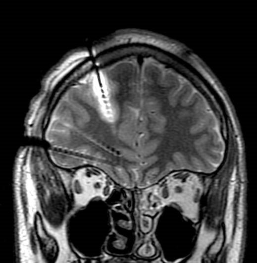 ep en la imagen se aprecia como ha sido implantado uno de los electrodos mostrando una lesion en esa