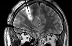 ep en la imagen se aprecia como ha sido implantado uno de los electrodos mostrando una lesion en esa