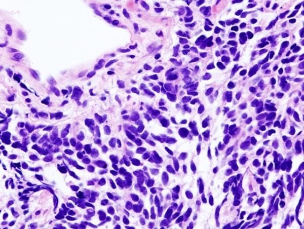 ep carcinomapulmoncelulas pequenas