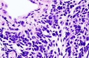 ep carcinomapulmoncelulas pequenas